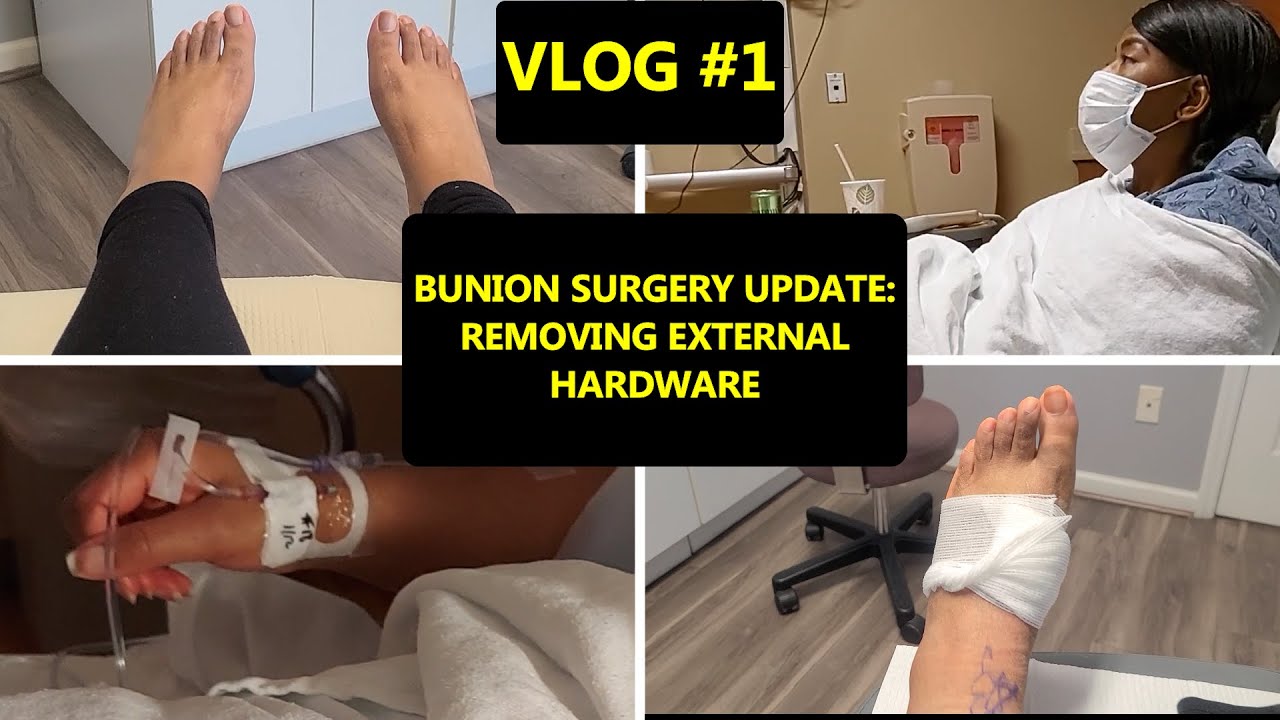 VLOG #1: Bunion Surgery Update | Metal Screw & Plate Removal Surgery Preparation | Surgery Day Recap