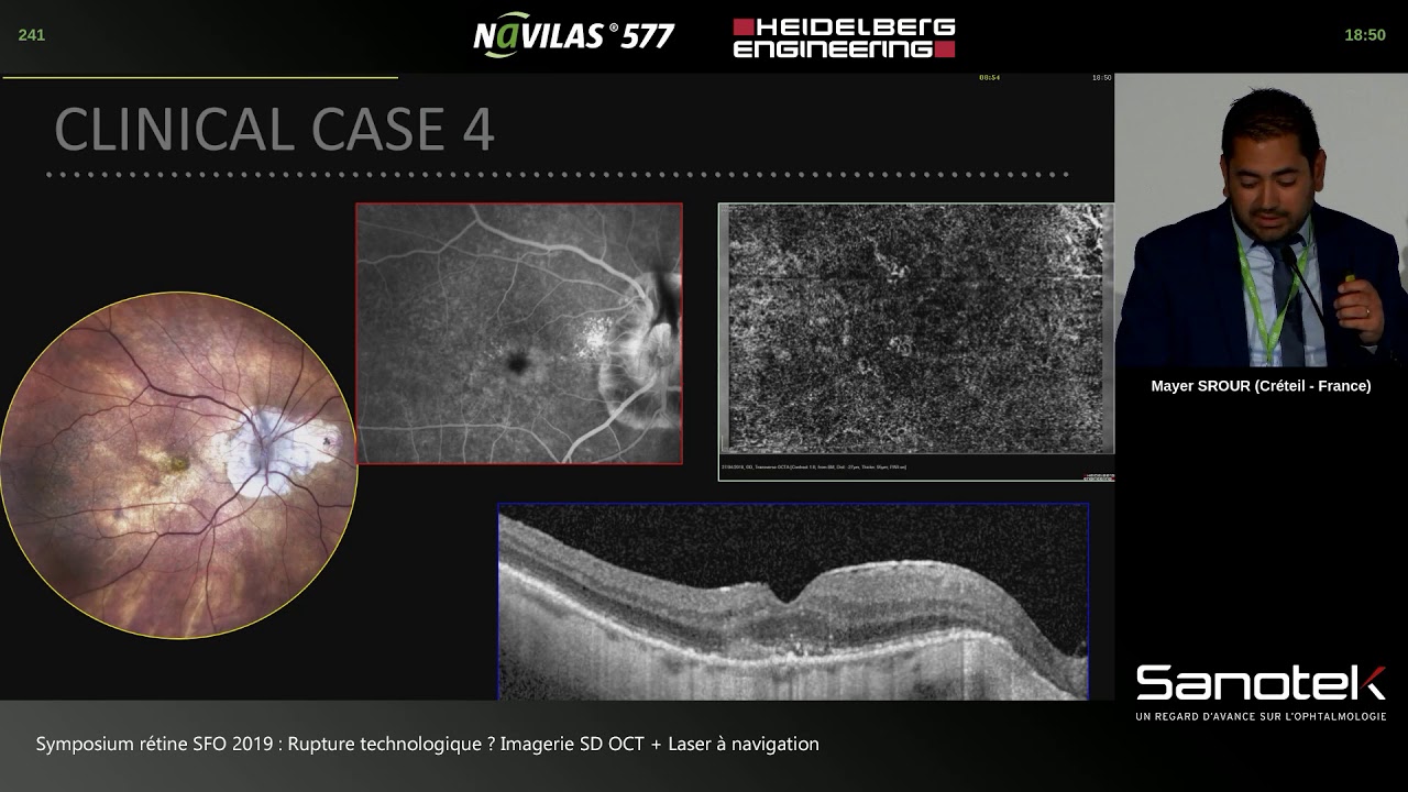 Cas cliniques OCT-A - Dr. Mayer SROUR (CHI Créteil)