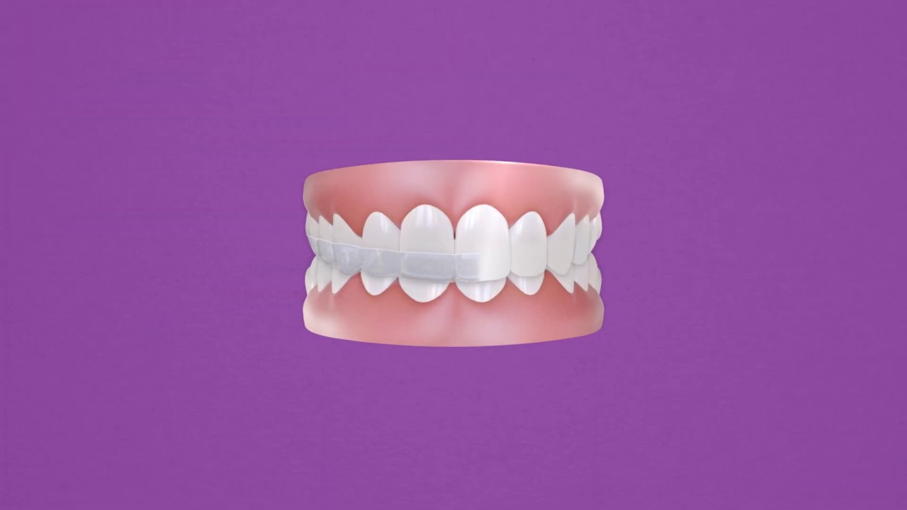 Impact&reg; Night Guards - Best Protection Against Teeth Grinding