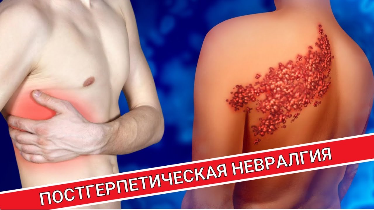 ПОСТГЕРПЕТИЧЕСКАЯ НЕВРАЛГИЯ ПОСЛЕ ОПОЯСЫВАЮЩЕГО ЛИШАЯ