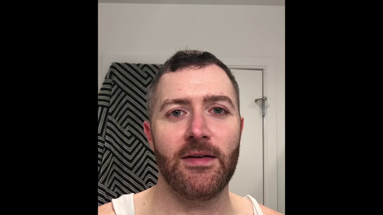 HAIR TRANSPLANT JOURNEY - WEEK 13 - HLC Ankara