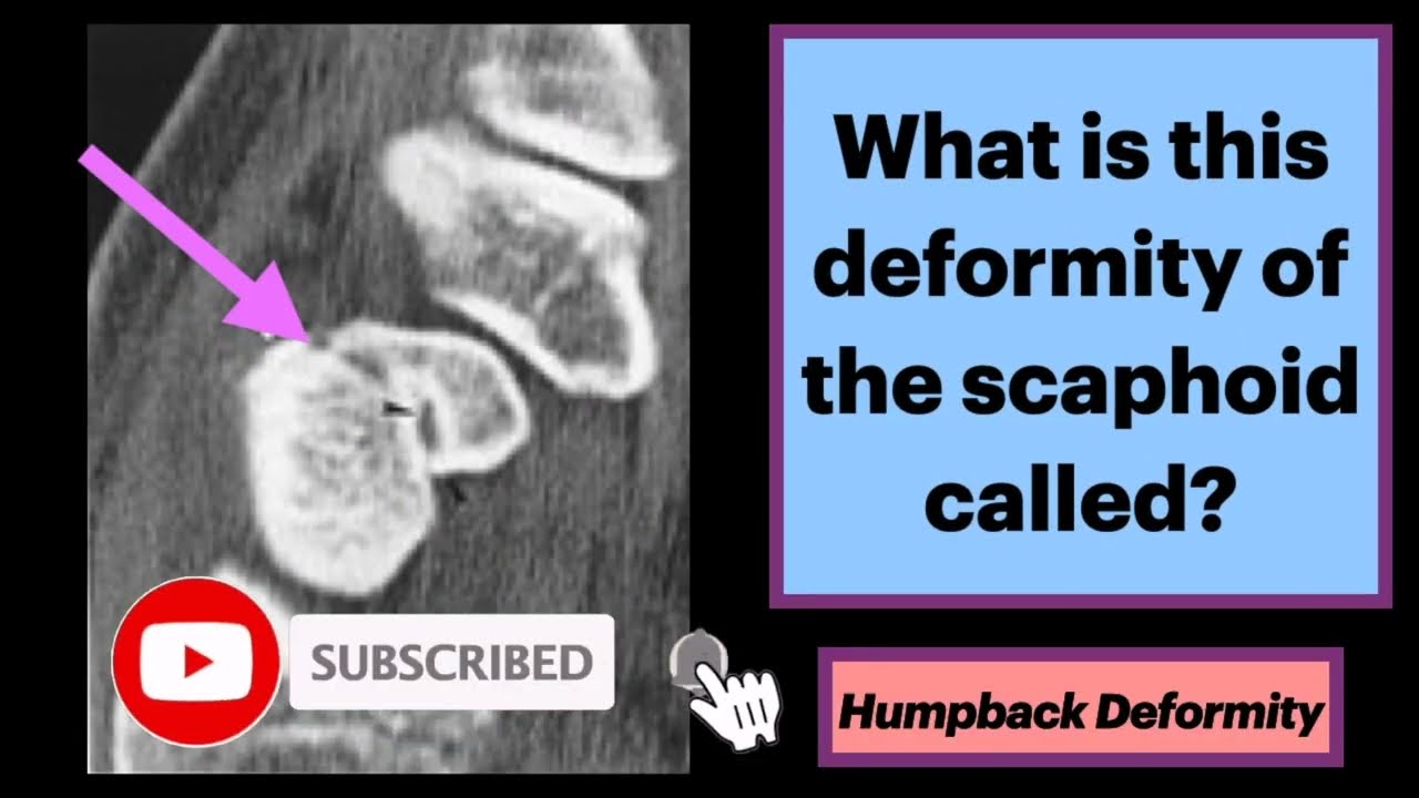 Scaphoid Fracture Humpback Deformity #Radiology #MSK #Orthopedics