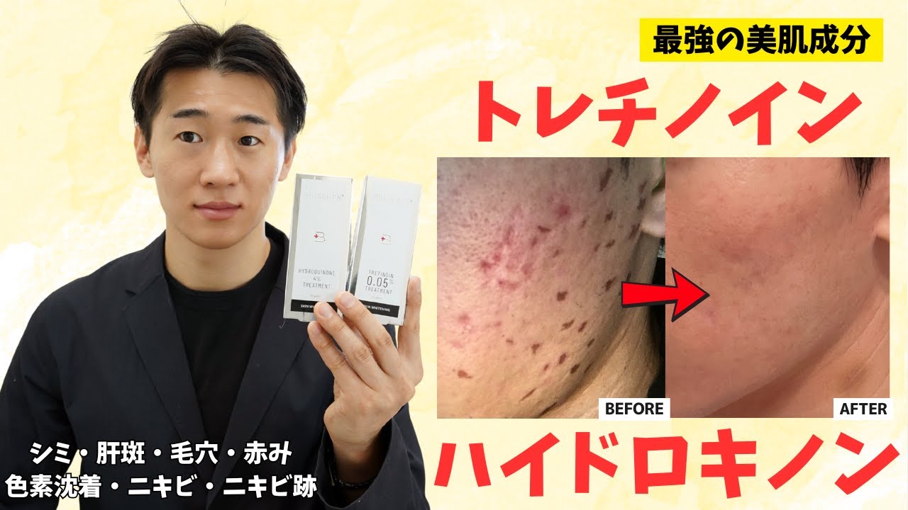 トレチノイン・ハイドロキノンの効果と使い方！経過から塗る順番とおすすめのクリームまで徹底解説💡【シミ・ニキビ・色素沈着・赤み・毛穴】