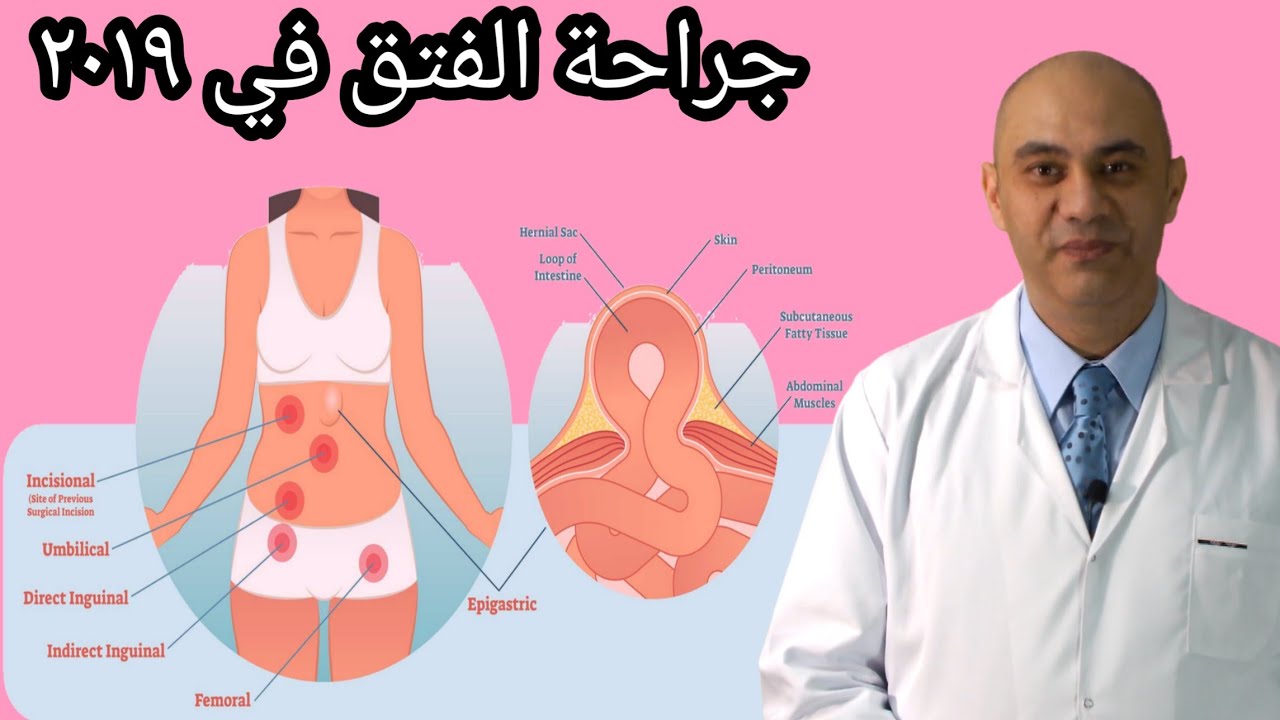 التطور الكبير في جراحات الفتق ٢٠١٩ (شرح كامل + عرض لجميع أنواع الشبك الحديث/هتفهم كل الجديد)