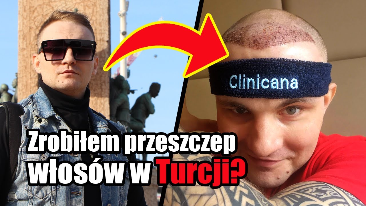 ZROBIŁEM PRZESZCZEP WŁOSÓW  W TURCJI  - VLOG odc 1