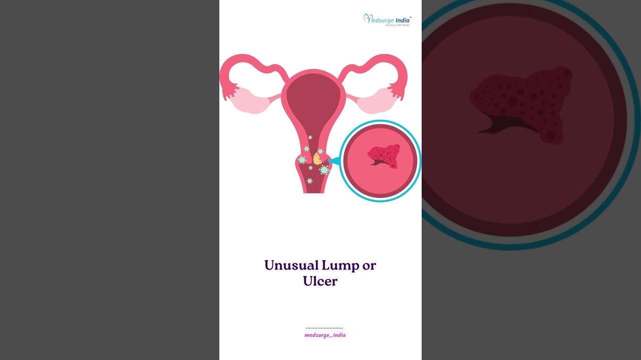 The Shocking Truth About Vulvar Cancer Symptoms #vulvarcancer #vulvarcancersymptoms #cancersymptoms