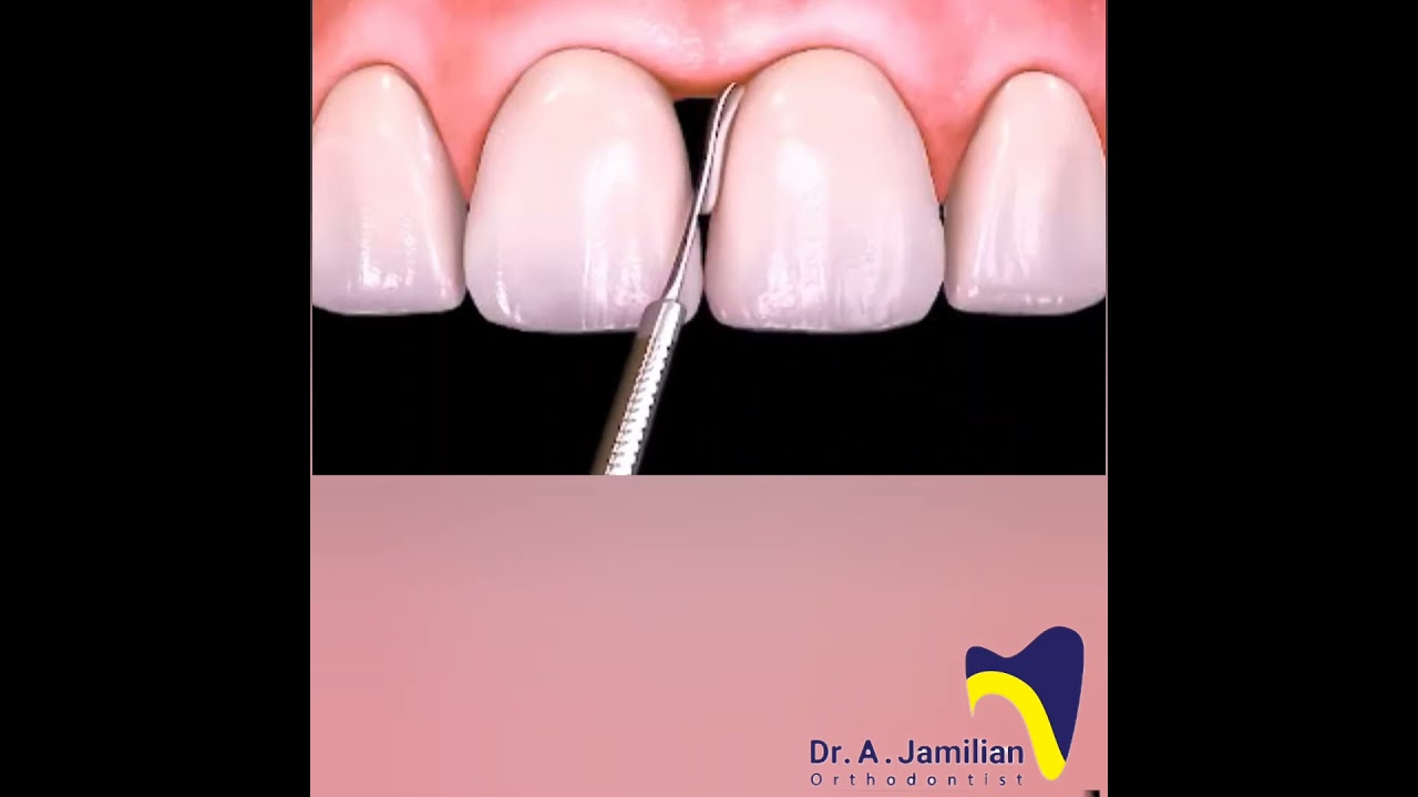 Come chiudere uno spazio tra i denti | Bonding composito per diastema #dentista #protesi #diastema