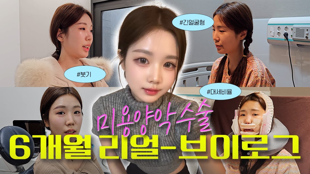 미용양악 리얼브이로그 “6개월의 변화, 저도 이렇게 될줄은 몰랐어요”