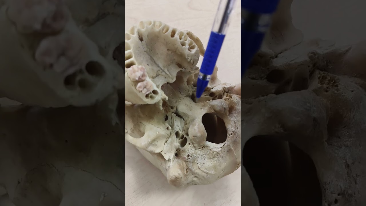 Jugular foramen