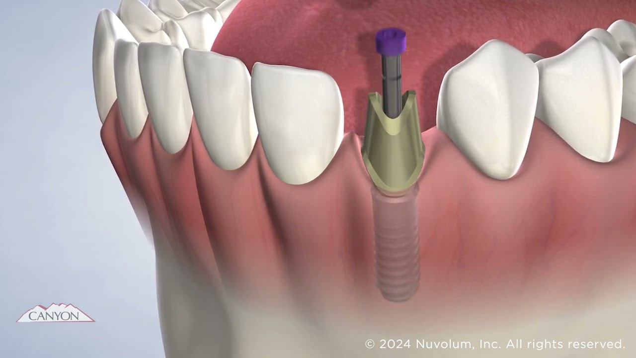Dental Implants: Everything You Need to Know | Las Vegas, NV