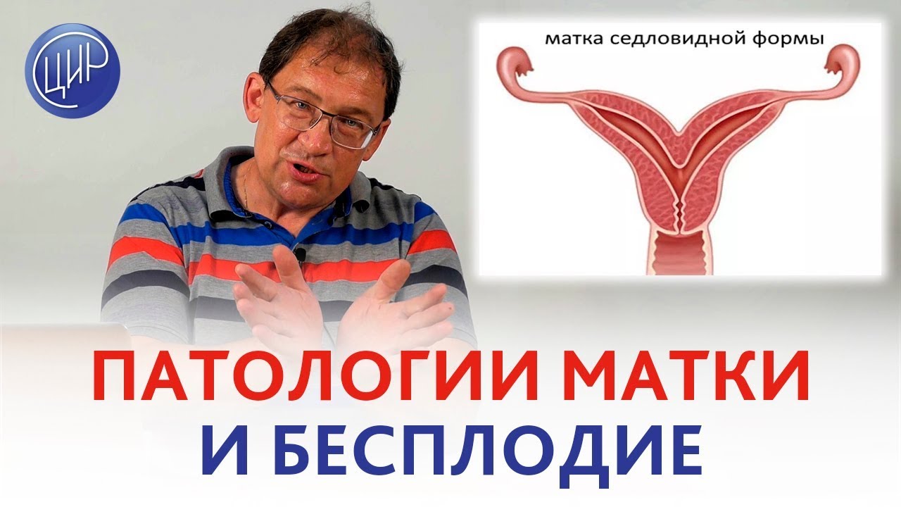БЕСПЛОДИЕ. Врождённые и приобретённые ПАТОЛОГИИ МАТКИ как причины бесплодия.