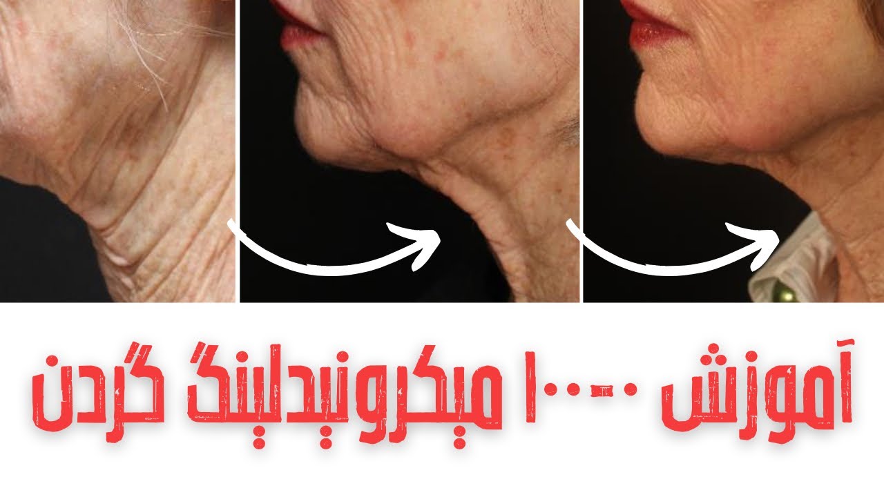 آموزش میکرونیدلینگ برای جوانسازی و لیفت گردن/درمان قطعی چین چروک گردن و پوست شل گردن با میکرونیدلینگ