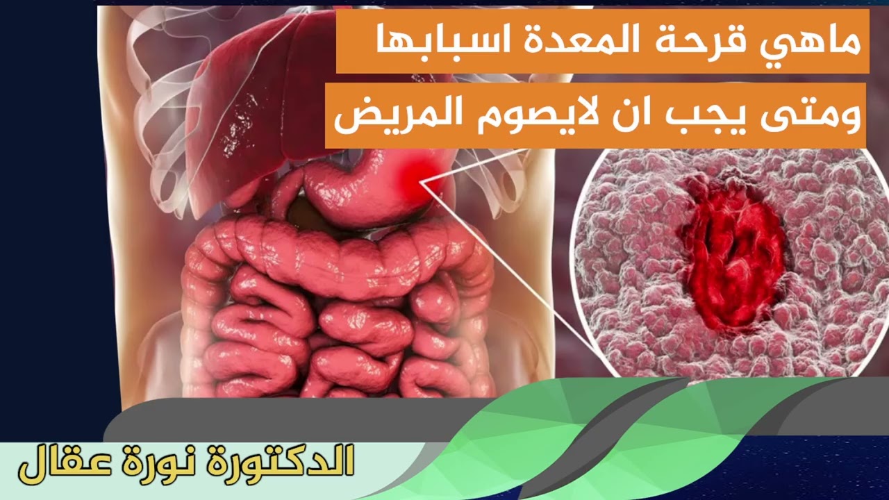 ماهي قرحة المعدة اسبابها ومتى يجب ان لايصوم المريض الدكتورة نورة عقال