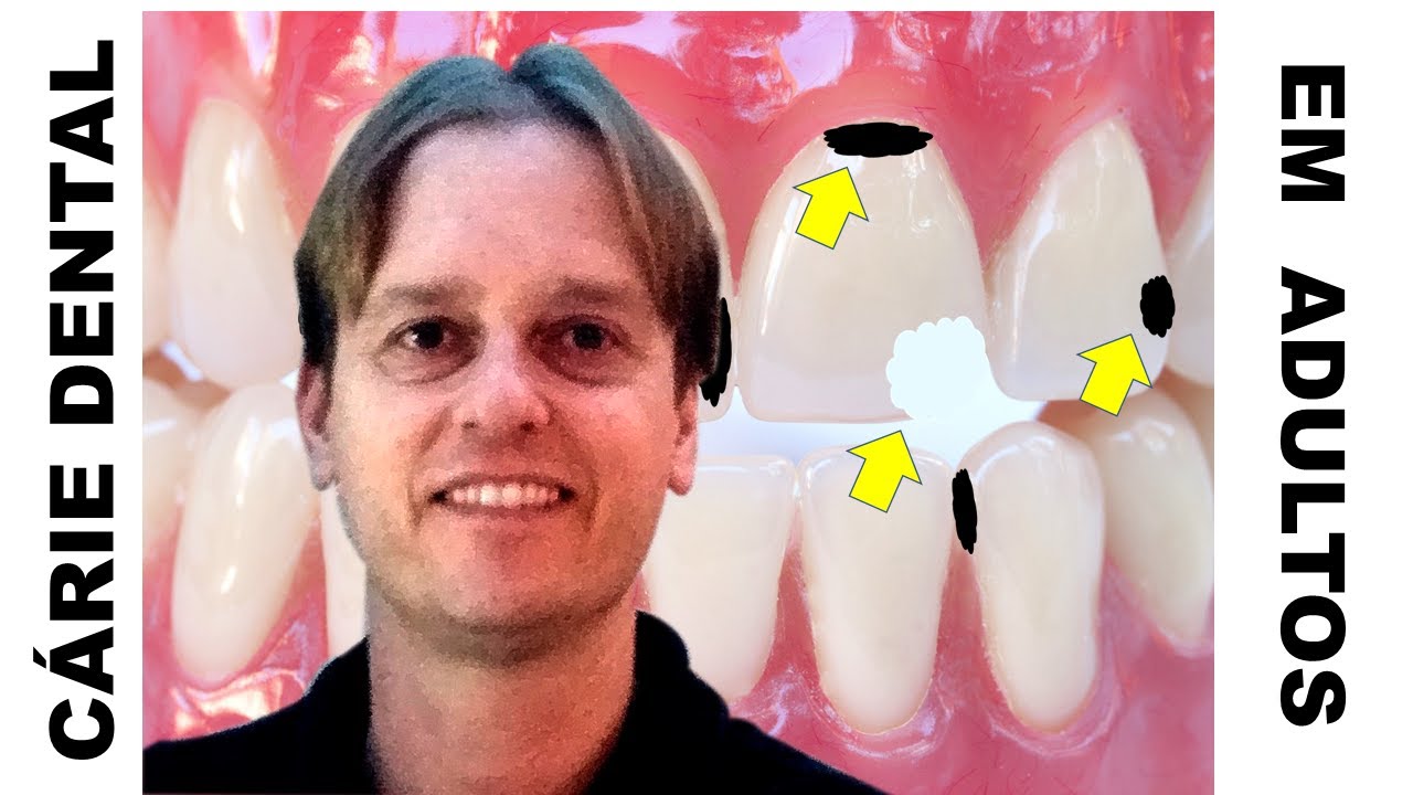 Como Evitar Cáries Nos Dentes Em ADULTOS? - Parte 1: Entendendo o que é REALMENTE a Cárie Dental