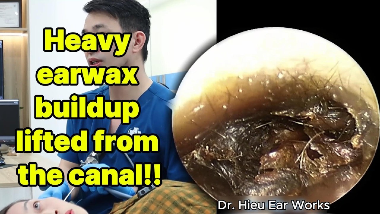 Heavy earwax buildup lifted from the canal | ear cleaning | ASMR earwax | soothing |relax|