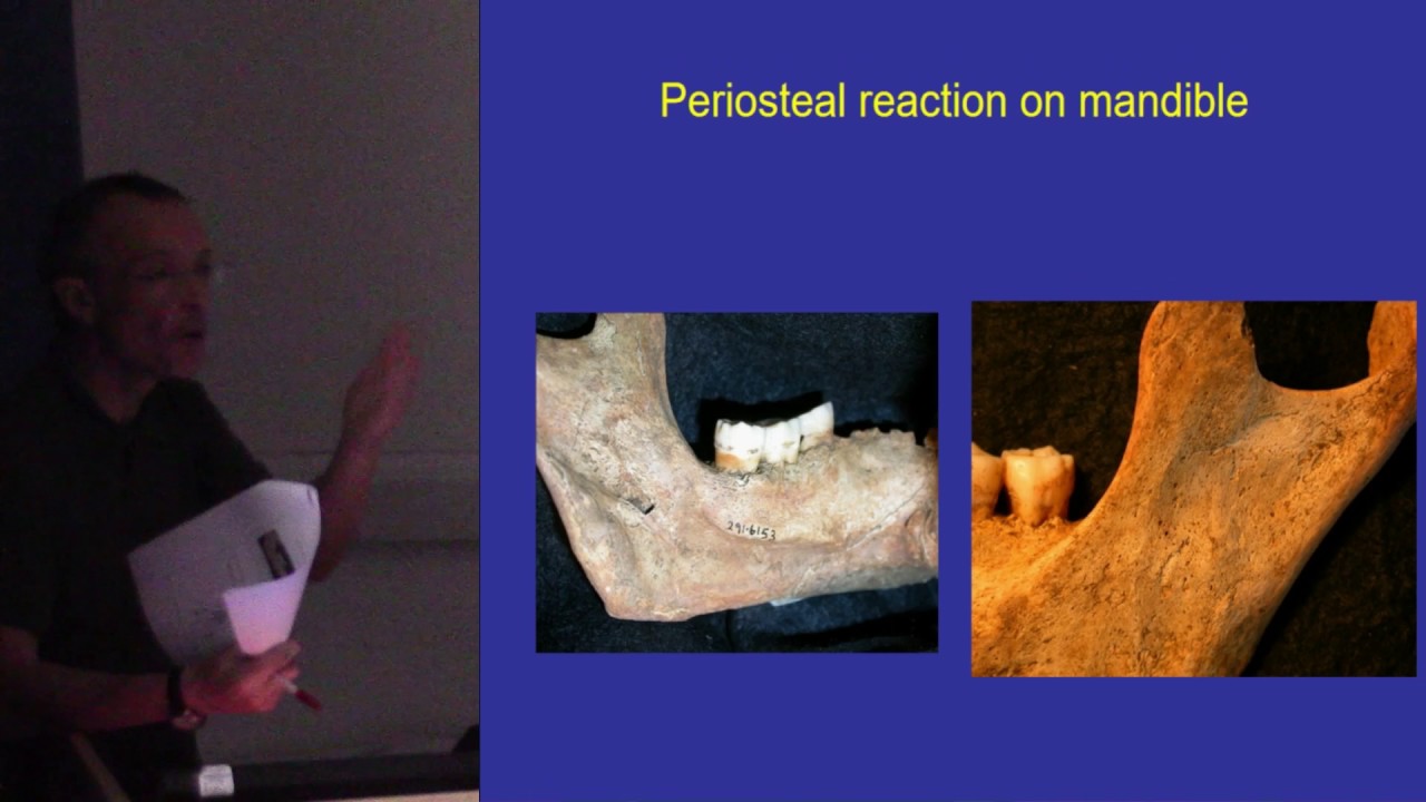The man with the stone in his mouth; and the symbolic replacement of severed body parts with objects