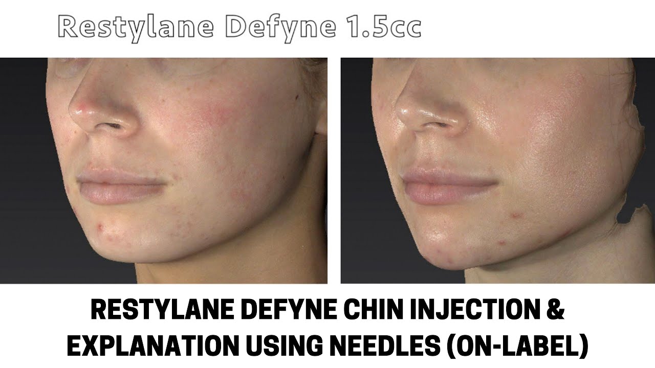 Инъекции препарата Restylane Defyne в подбородок и пояснения по применению игл (по инструкции) — ...