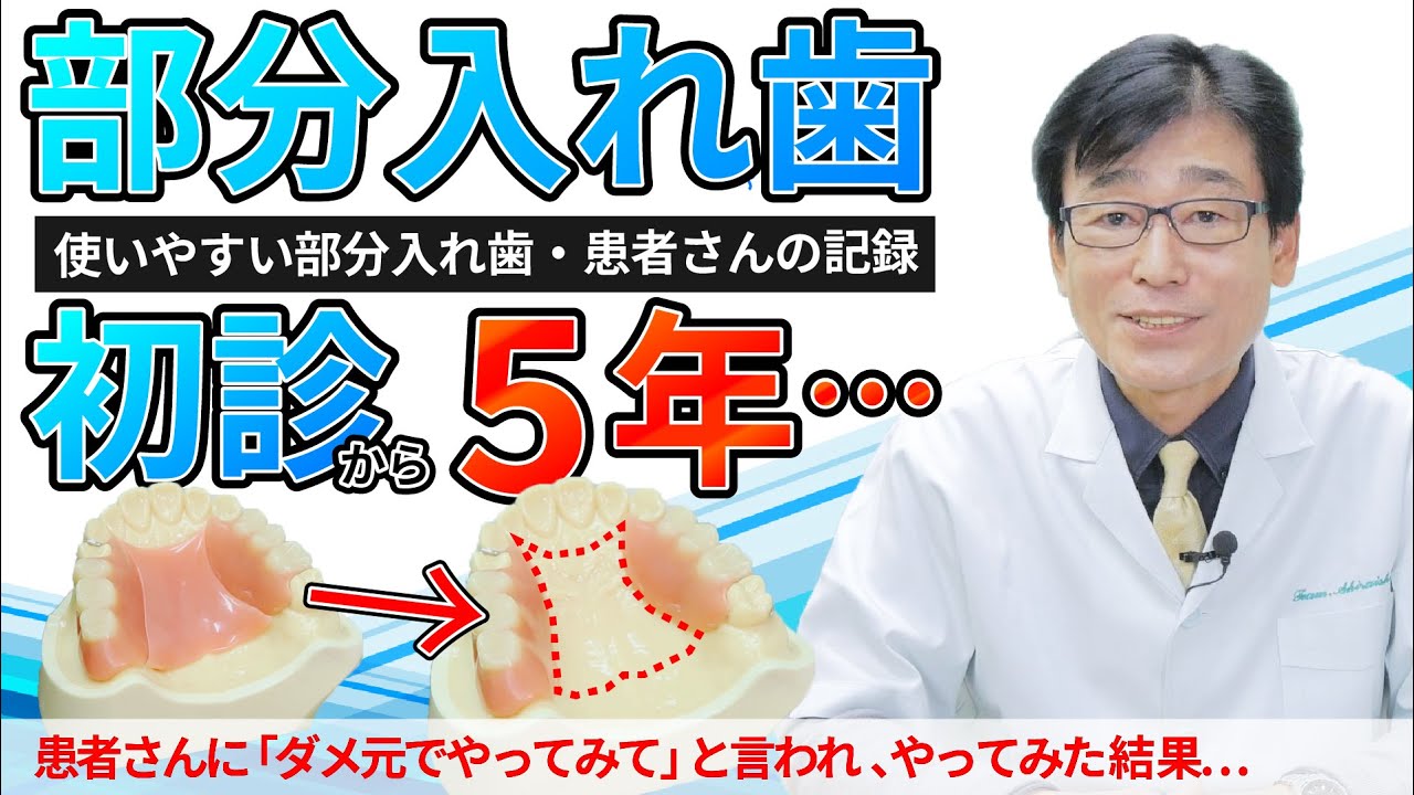 【 入れ歯・部分入れ歯 】初診 から ５年後… 　部分入れ歯を、左右別々に「ダメ元で作ってみて」と言われ作った結果…（入れ歯・義歯・咬み合わせ）