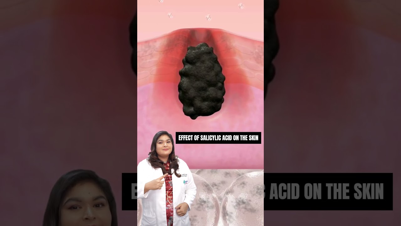 Magic of Salicylic Acid on Skin #salicylicacid  #skinfinityderma#dermatologist #dripshitajohri