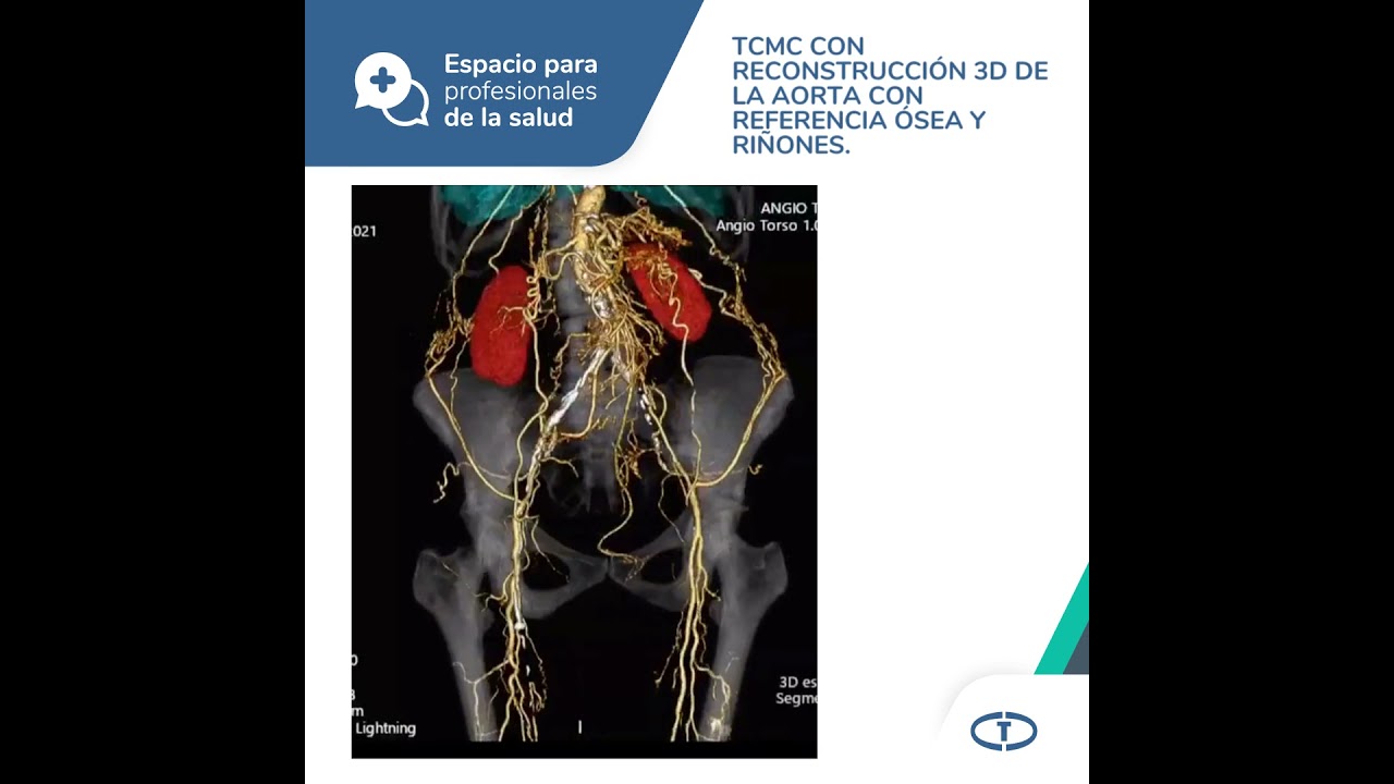 Espacio para profesionales de la Salud - Sindrome de Leriche