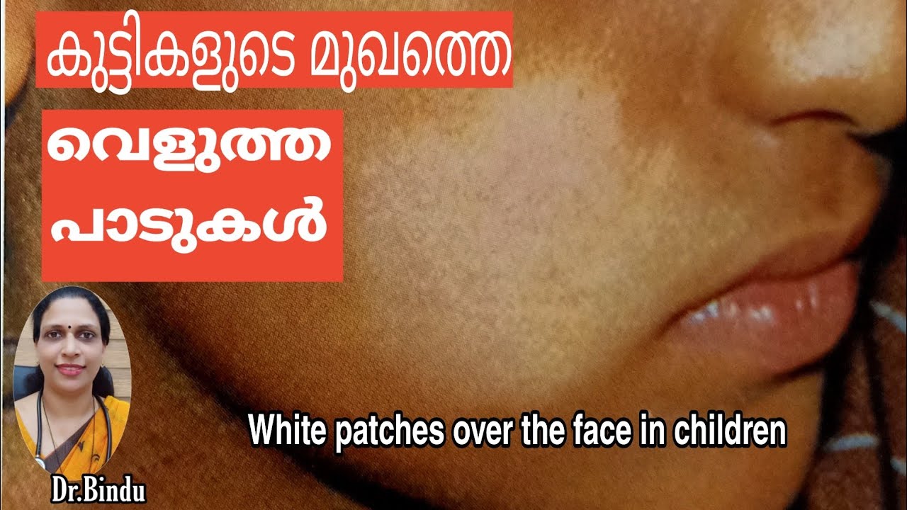 White patches over the face in children/കുട്ടികളുടെ മുഖത്തെ വെളുത്ത പാടുകൾ/parenting tips