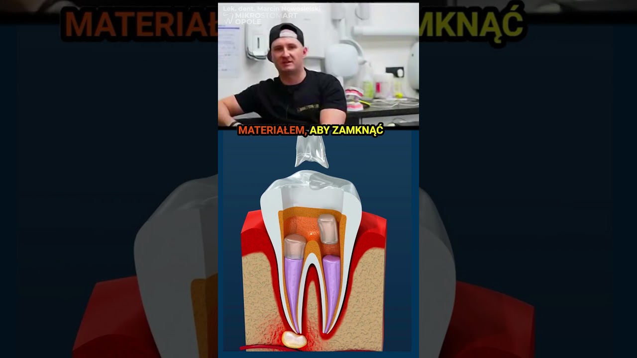 😱Jak Wygląda Leczenie Kanałowe?🦷😳 (Krok Po Kroku) (Animacja 3D)