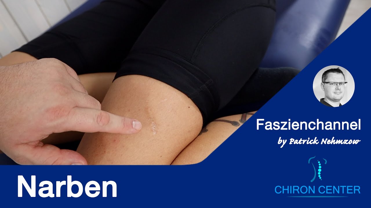 Narben, Narbenbehandlung Warum Du Deine Narbe einmal checken lassen solltest