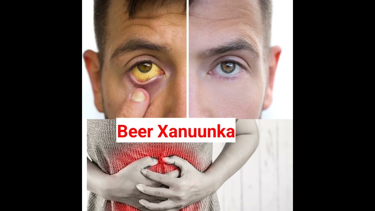 Cudurada Beerka , calaamadaha Lagu garto , Baaritaanada loo sameeyo iyo sida loo daaweeyo