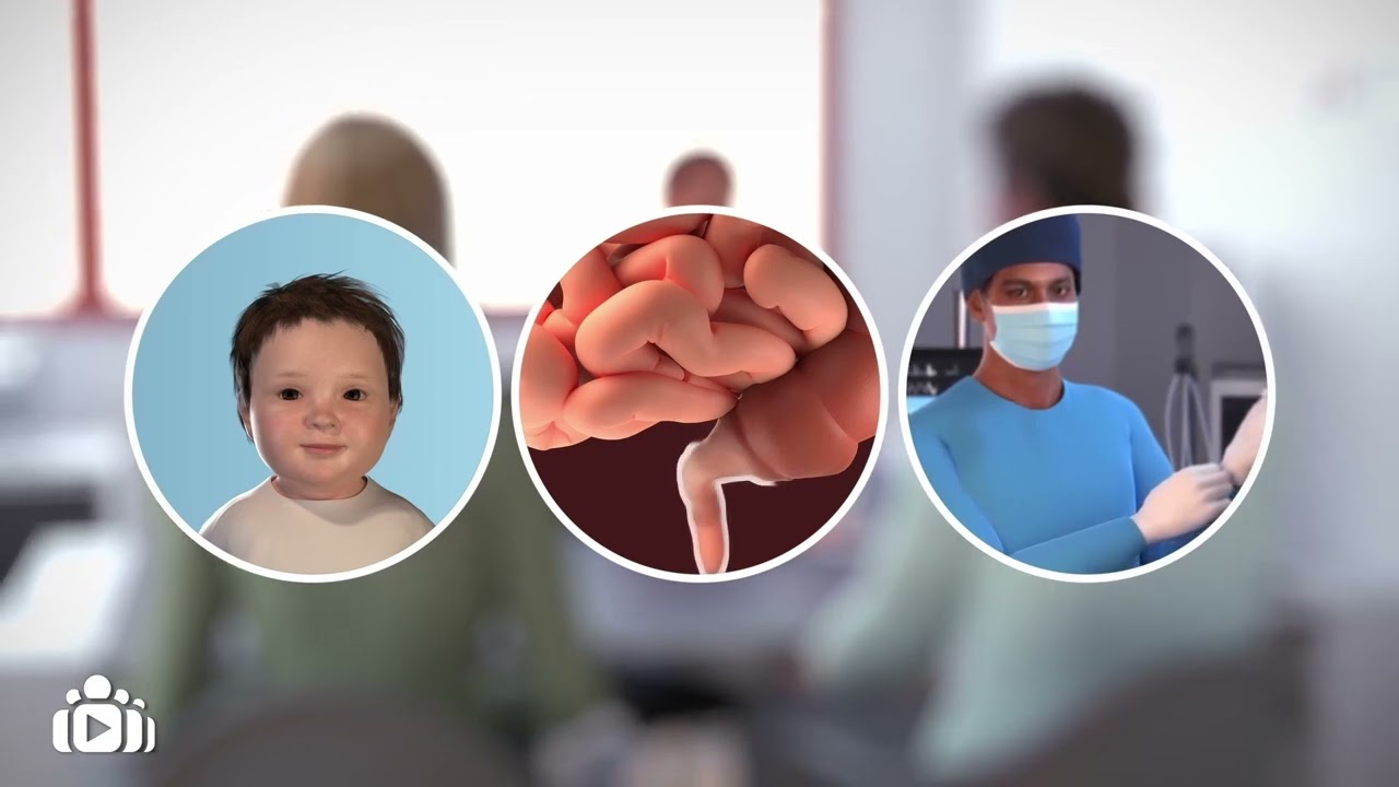 Surgical treatment for Hirschsprung’s Disease: An ERNICA animation for parents and families