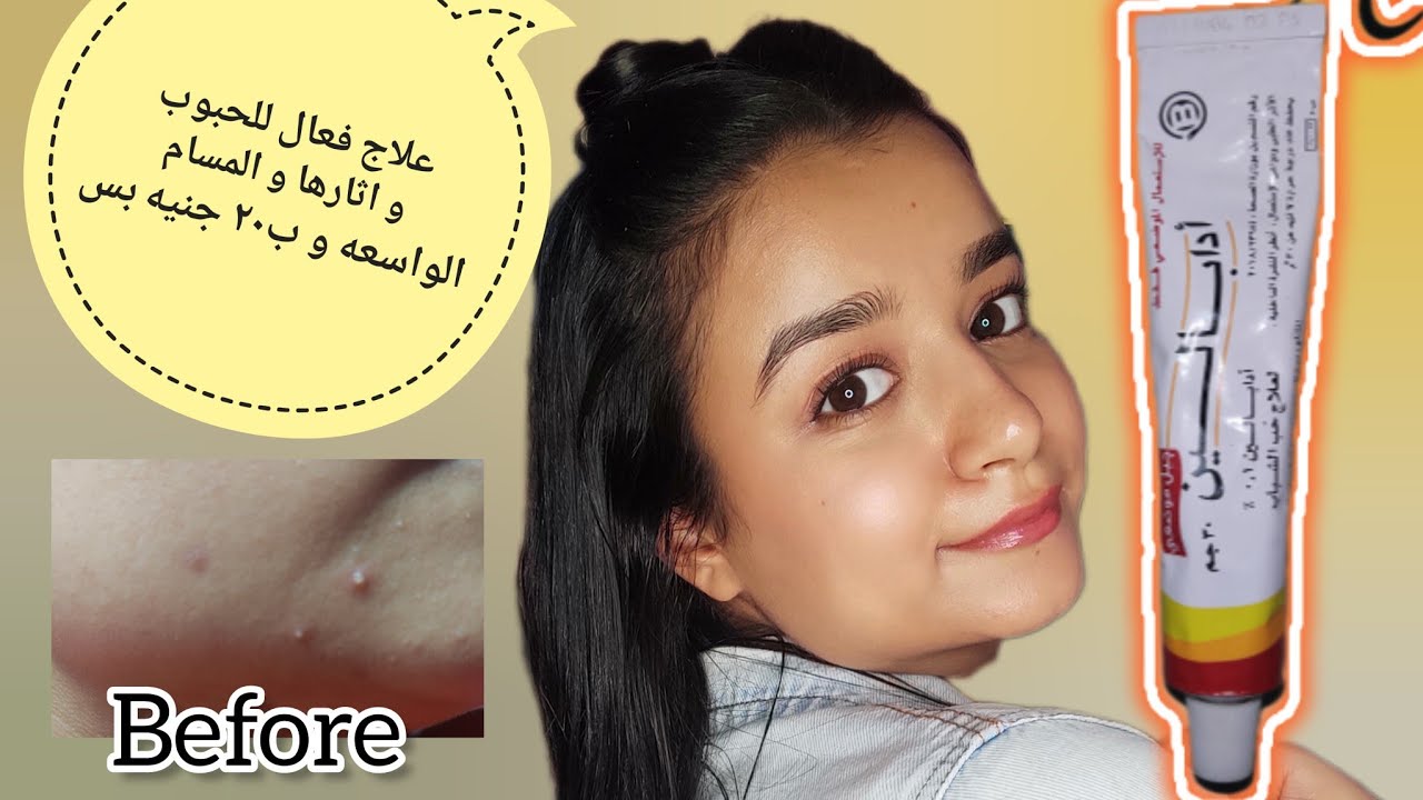 الادابالين علاج المسام الواسعه و الحبوب و اثار الحبوب