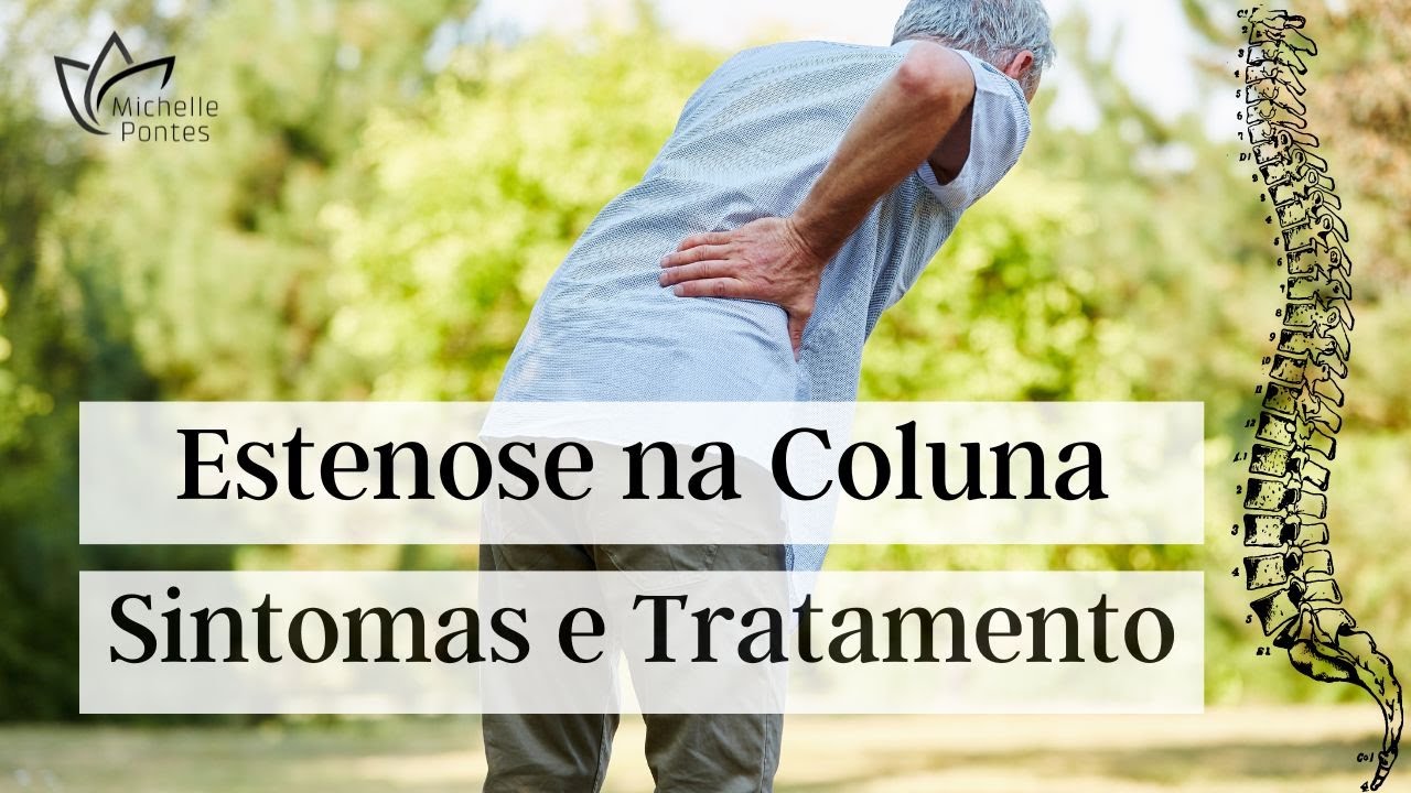 Estenose na Coluna: Sintomas, Tipos e Tratamentos