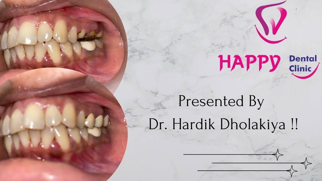 Journey from consultation to final prosthesis : zirconia crowns before and after. #crown #zirconia