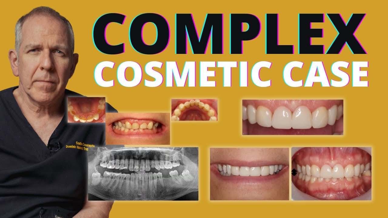 Anterior Tooth Wear Restoration with Bioclear, Implants & Dahl Techniques