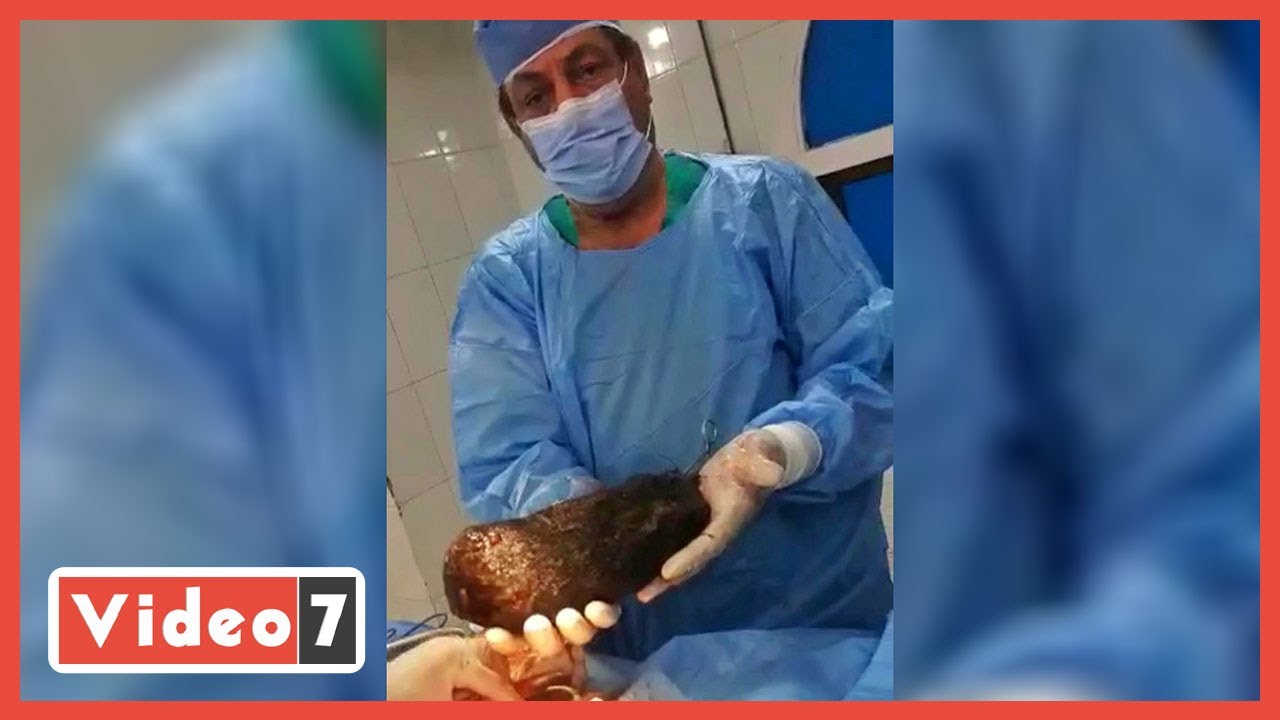أغرب عملية فى مصر!.. استخراج 3 كيلو شعر من بطن مريض فى مفاجأة مذهلة للأطباء..