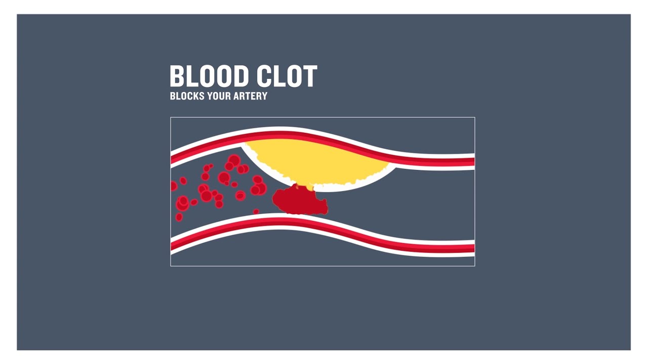 Coronary heart disease, clogged arteries and atherosclerosis