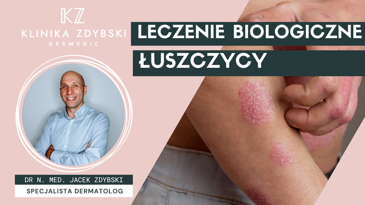 Dermatolog m&oacute;wi o: Prywatne leczenie biologiczne łuszczycy