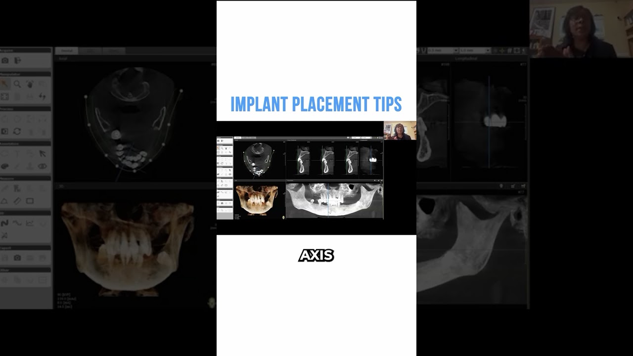 Implant Placement Tips