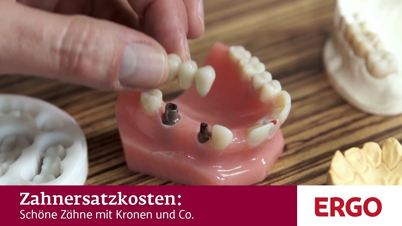Sch&ouml;ne Z&auml;hne mit Kronen und Co.: Welchen Zahnersatz gibt es? - ERGO Deutschland