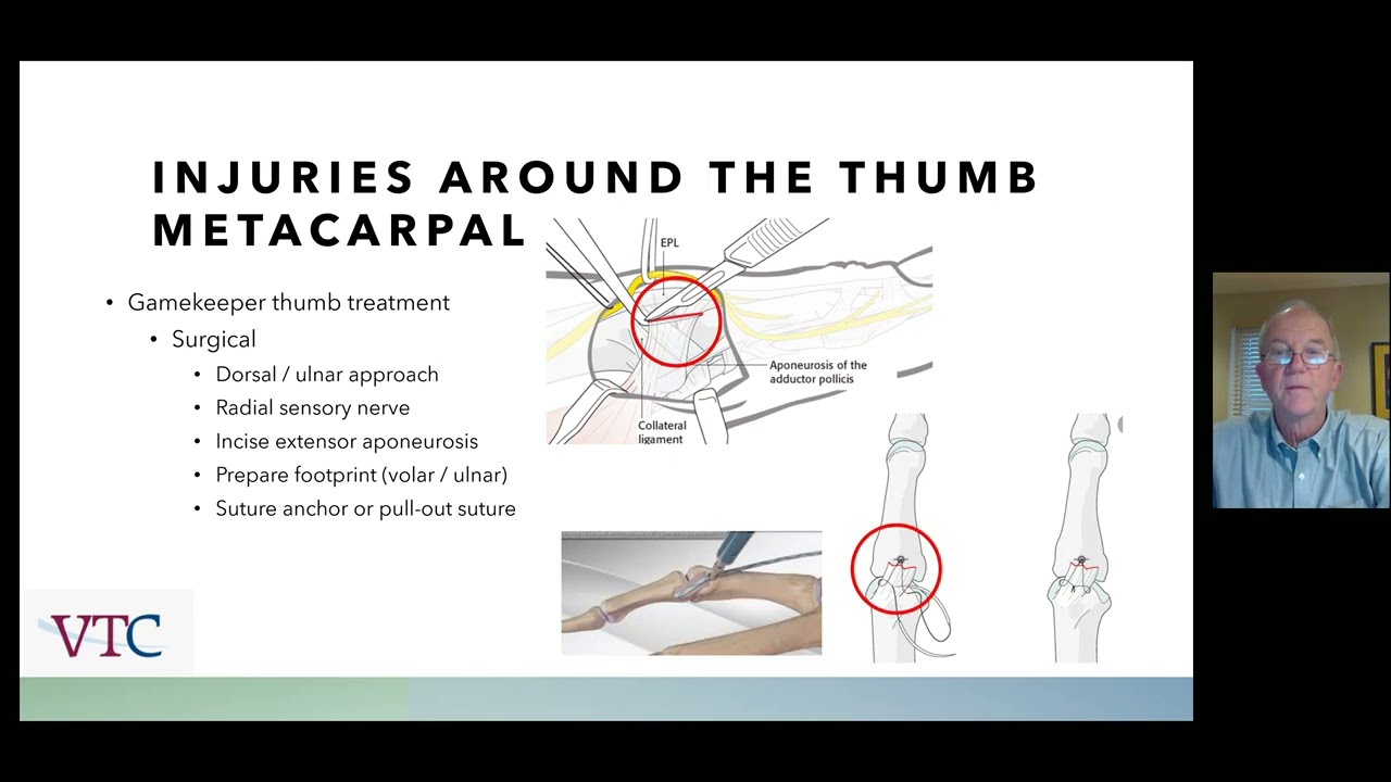 Injuries Around the Thumb Metacarpal - Dr. Hagan - 03/06/23