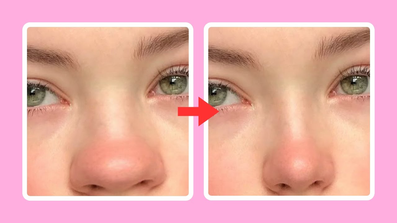 easy nose slimming exercises, reshape your nose in just 7 days!
