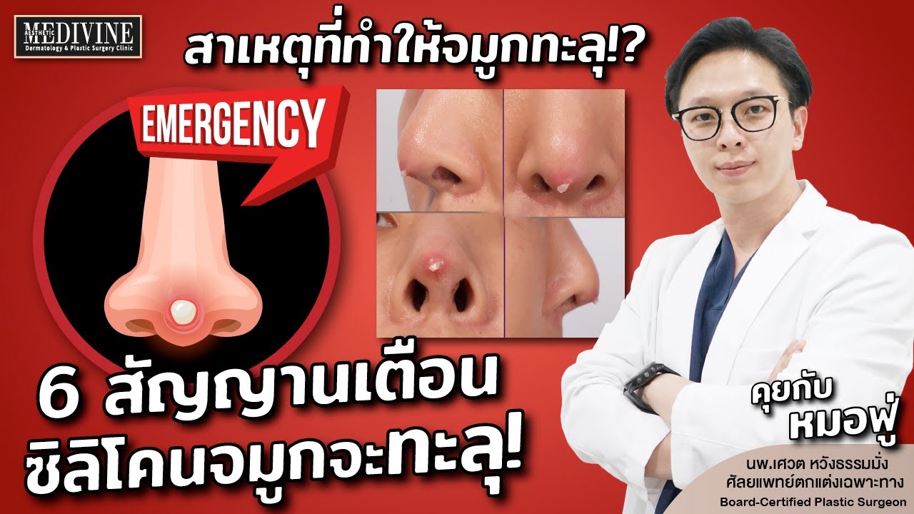6 สัญญาณเตือน ซิลิโคนจมูกใกล้ทะลุ!! ปลายจมูกบาง จมูกแดง ต้องรีบแก้จมูกด่วน! สาเหตุที่ทำให้จมูกทะลุ??