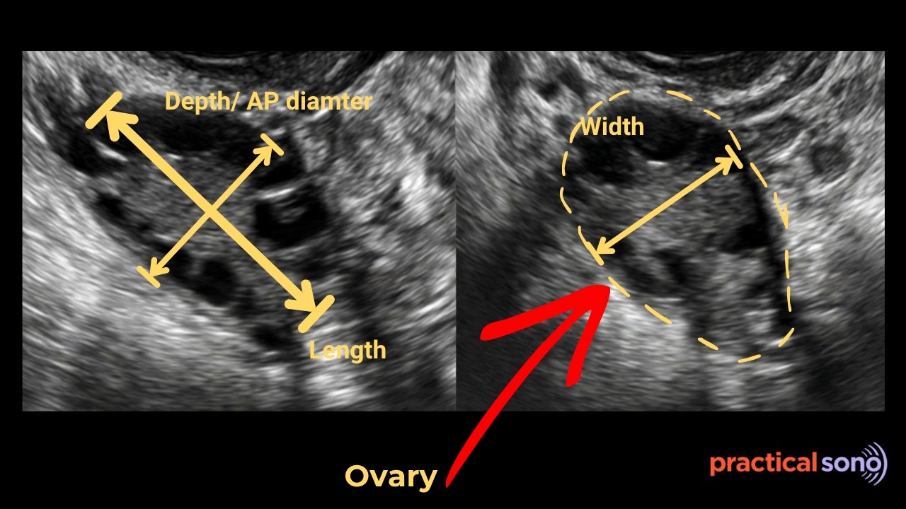 Ovarian Volume Measurement Ultrasound |Length, Width, And Depth Measurement (TVS & TAS)