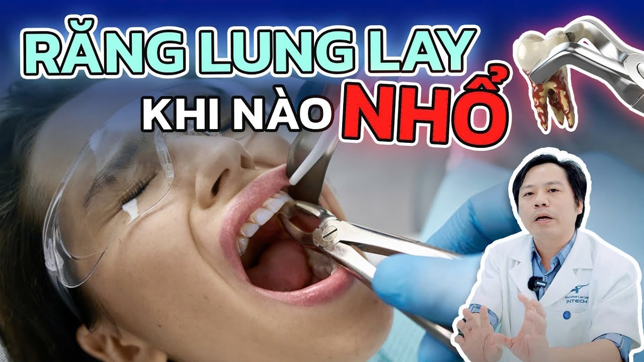 Răng Lung Lay Khi Nào Nên Nhổ? 3 Trường Hợp “Không Thể Trì Hoãn” Nếu Răng Lung Lay