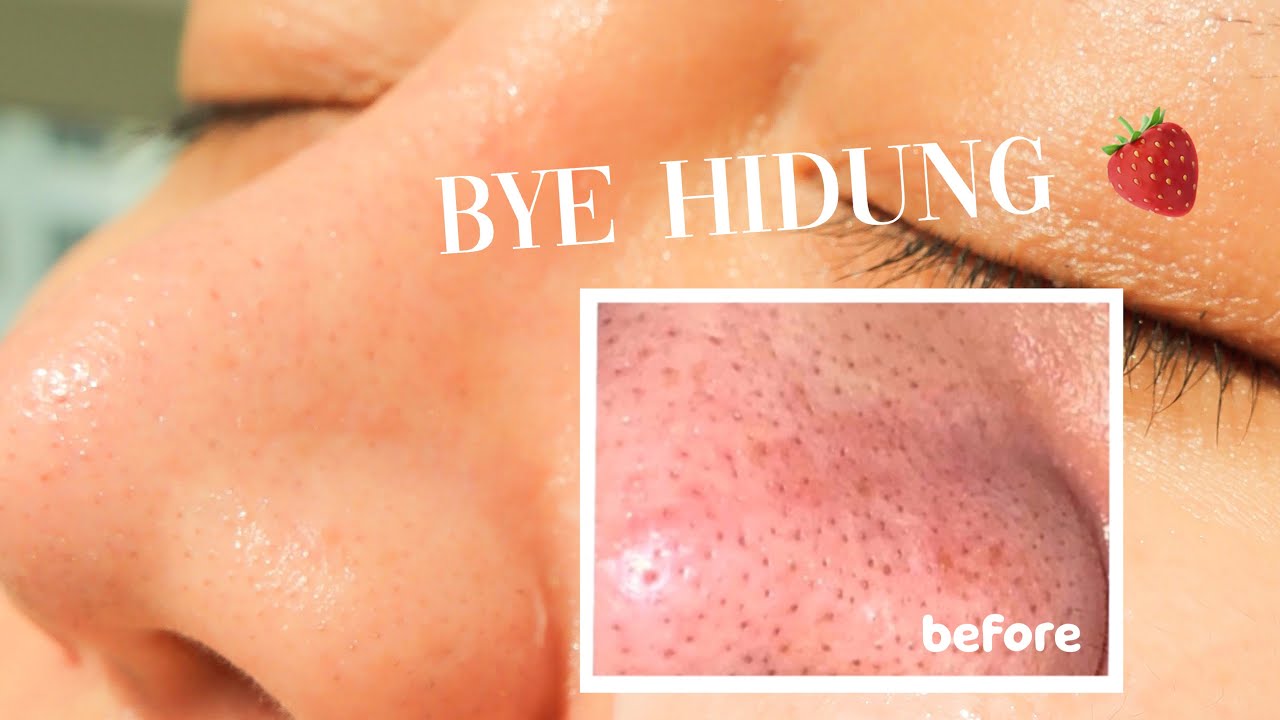 KURANGI KOMEDO PERMANEN!!! personal tips // bye hidung stroberi!!