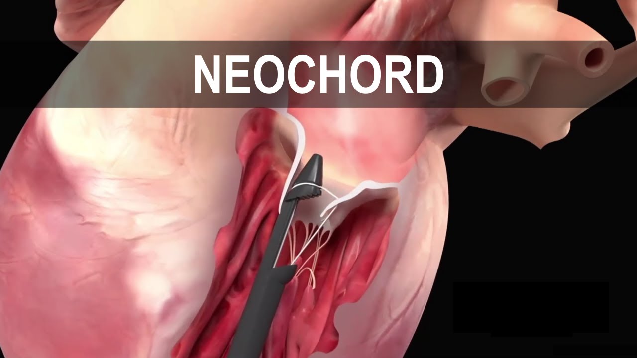 NEOCHORD YÖNTEMİ | Kalp Çalışırken Yapılan Kalp Kapağı Tamiri