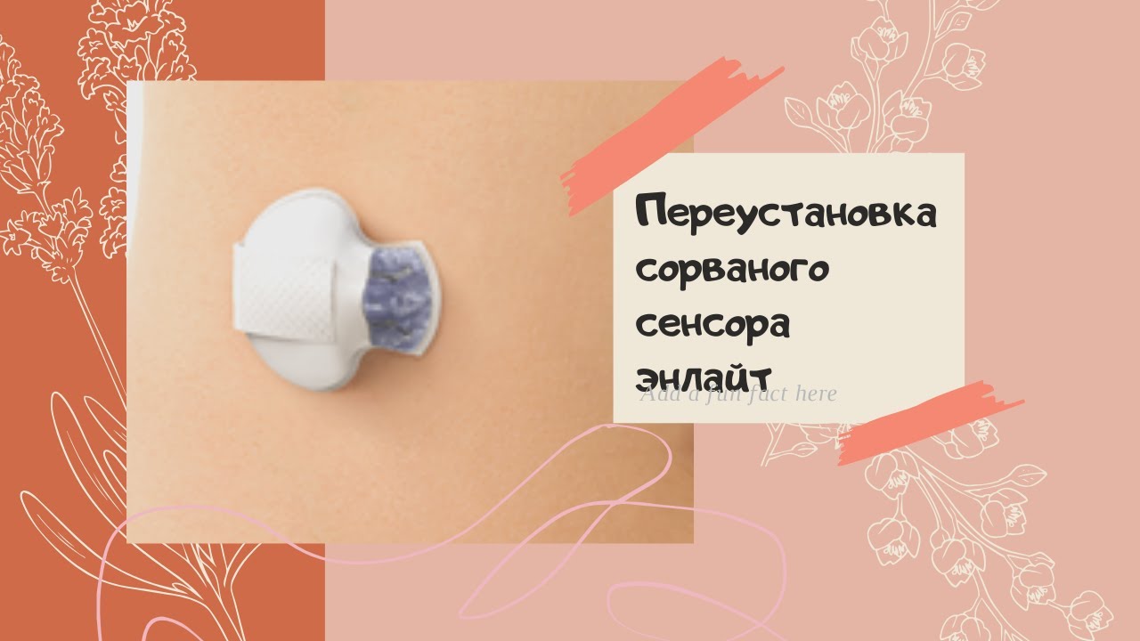 Переустановка сенсора Энлайт (Enlite) Медтроник