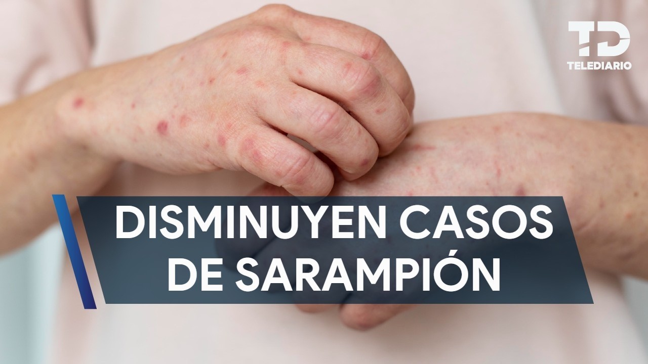 Disminuyen significativamente los casos de sarampión en Jalisco