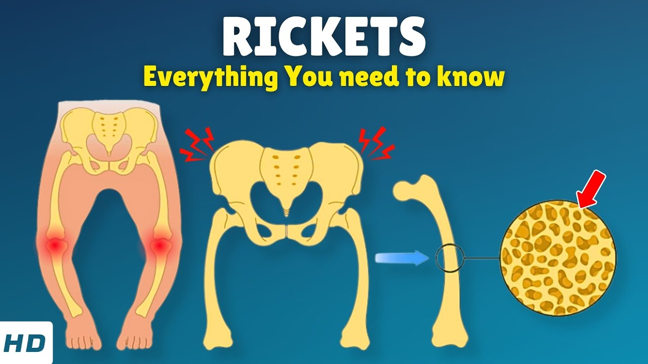 Rickets &ndash; Causes, Signs and Symptoms, Diagnosis & Treatment