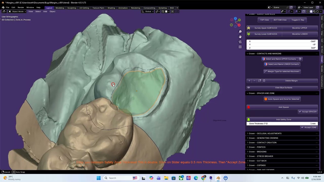 Making an Onlay and refining occlusion.