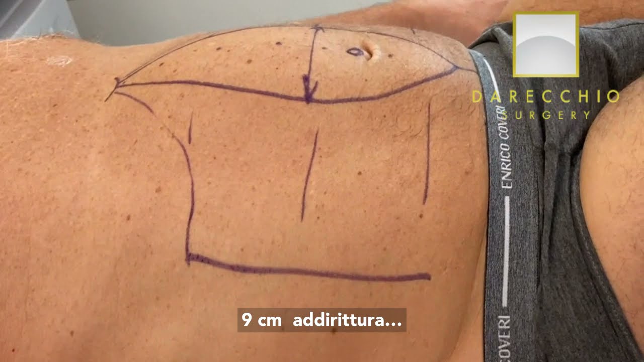 Diastasi Addominale Maschile | Intervento |  Dr. Darecchio